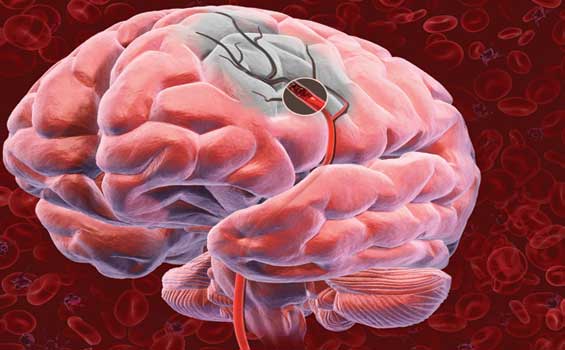 Así será el tratamiento del derrame cerebral en el futuro