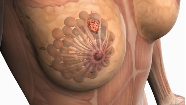 Cómo reducir el riesgo de cáncer de mama