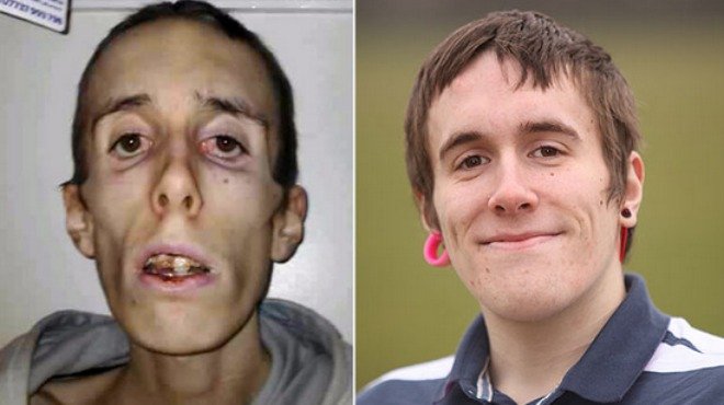 Joven con anorexia muere 20 minutos y revive - Fotos