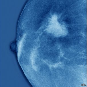 Solucionan el enigma sobre el origen del cáncer de mama