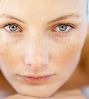 Tipos y tratamientos de manchas faciales