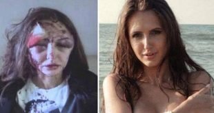 La modelo que fué desfigurada por su exnovio multimillonario - Fotos