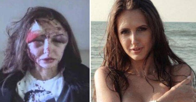 La modelo que fué desfigurada por su exnovio multimillonario - Fotos